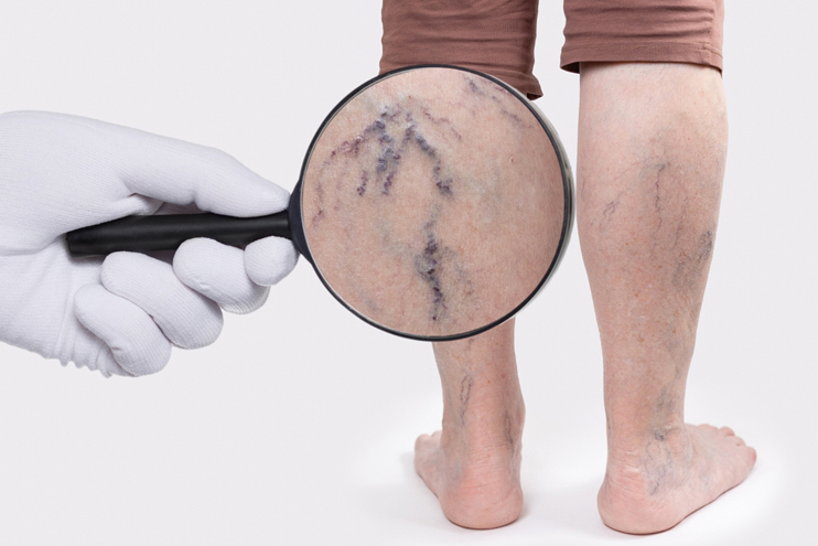 Vein Stripping