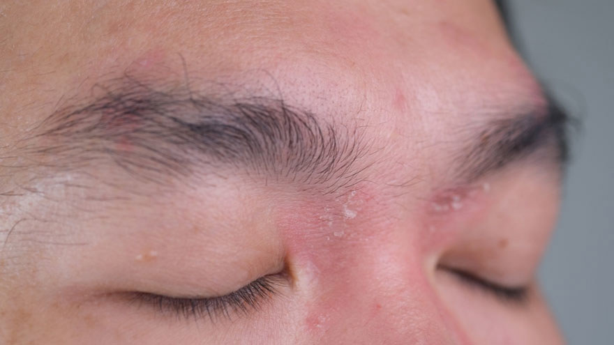 Skin Conditions