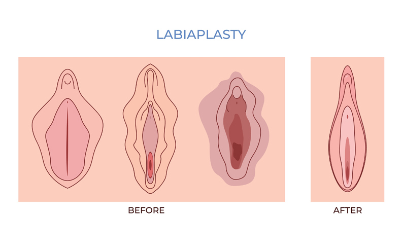 Medical diagram illustrating labiaplasty anatomy changes before and after laser surgery