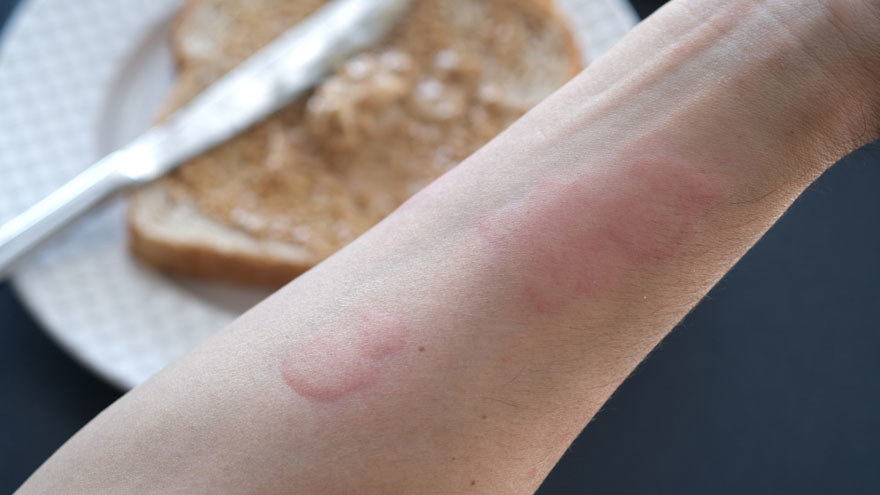 Severe Allergic Reactions