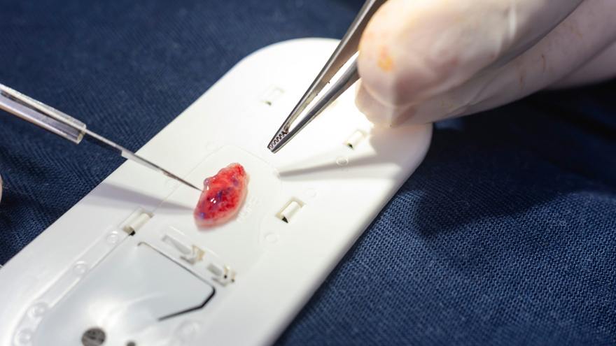 Cartilage Graft