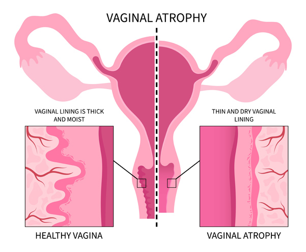Menopause and Vaginal Dryness Clinic Treatment Process