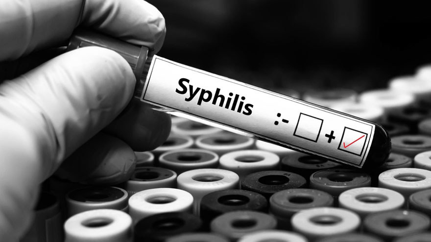Shingles