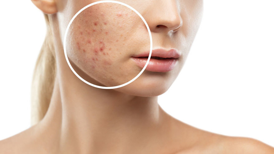 pigmentation treatment
