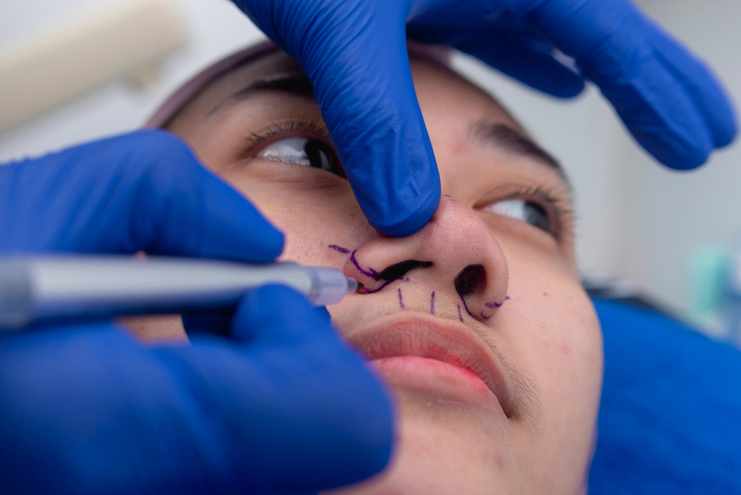 Rhinoplasty in Correcting a Bulbous Nose