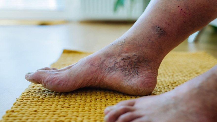 Chronic wounds