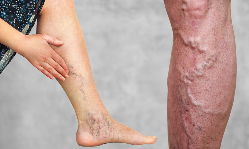 Untreated Varicose Veins