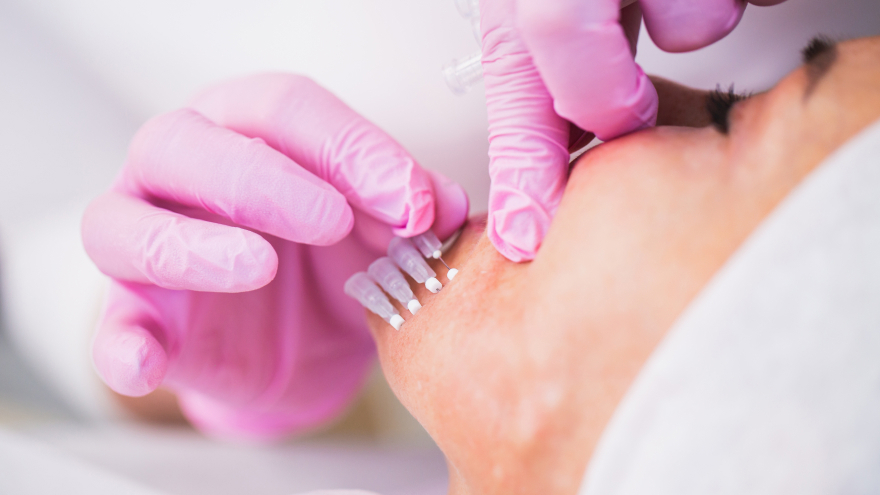 Mint Thread Lifting Treatment in Dermatology Petit/Skincare