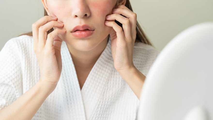 Overcoming Redness and Rosacea