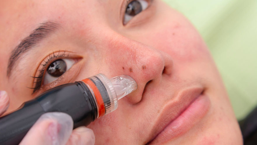 Skin Resurfacing Treatment