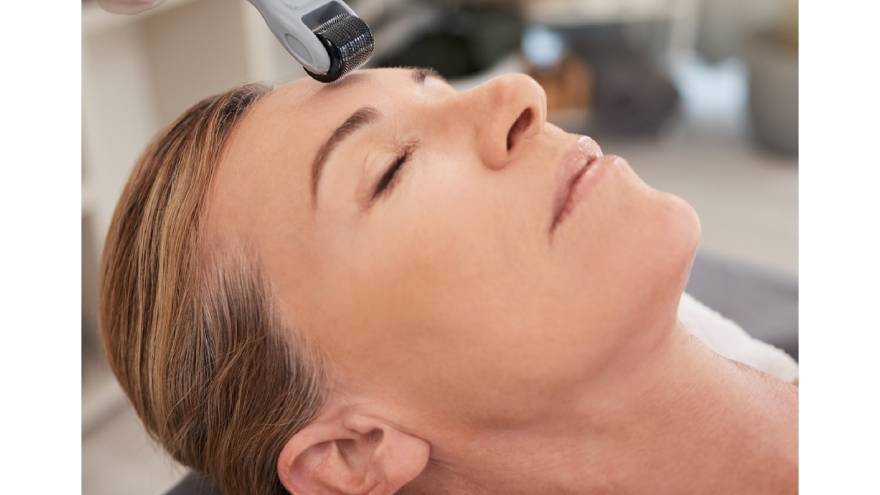 RF microneedling