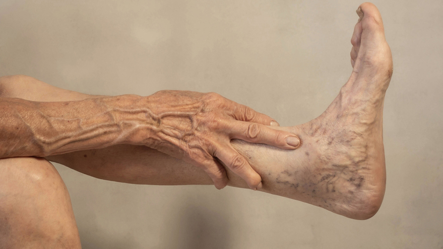 Developing Varicose Veins