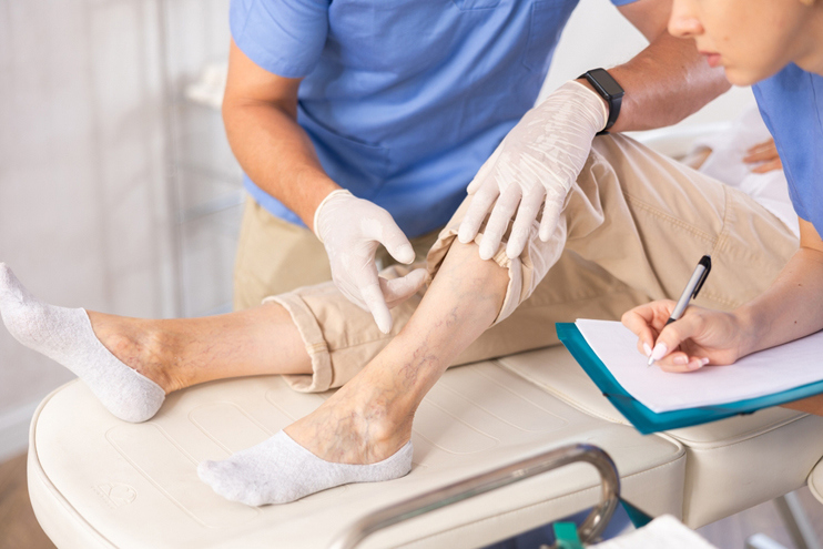  Varicose Vein Cosmetic Treatment