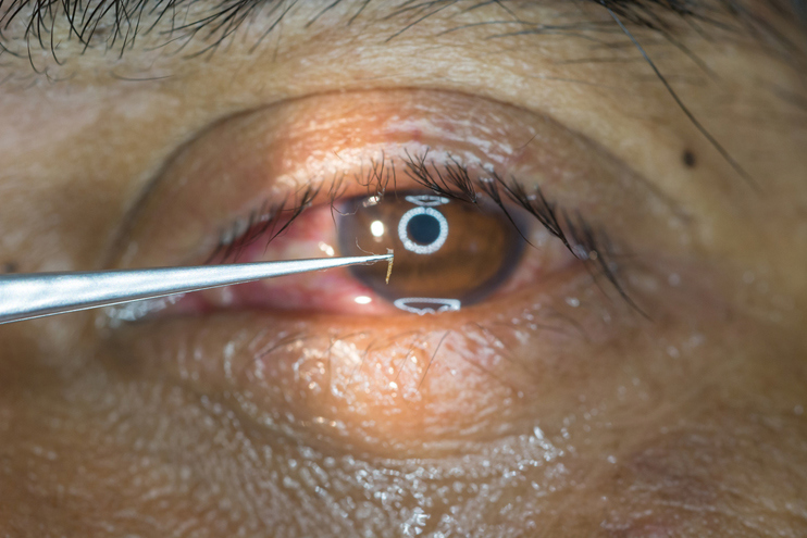 Minimal Corneal Tissue Removal