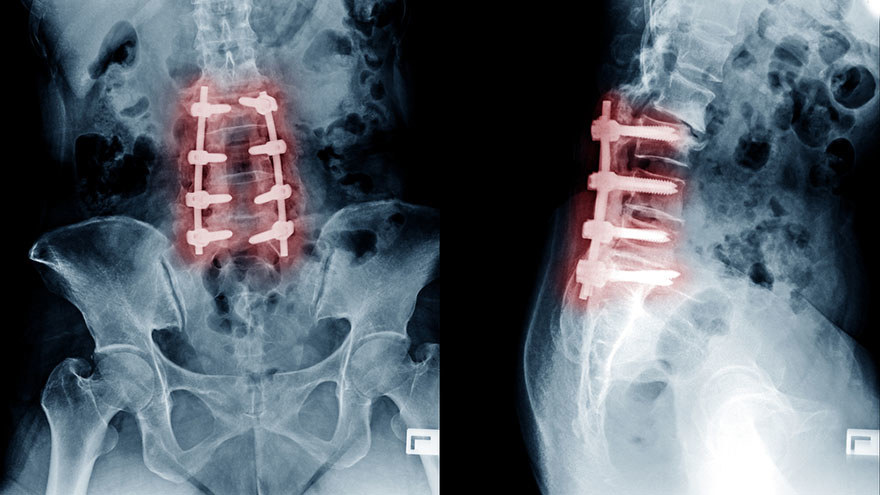 Spinal Disc Degeneration