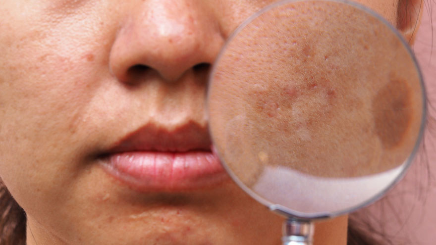 Managing Melasma