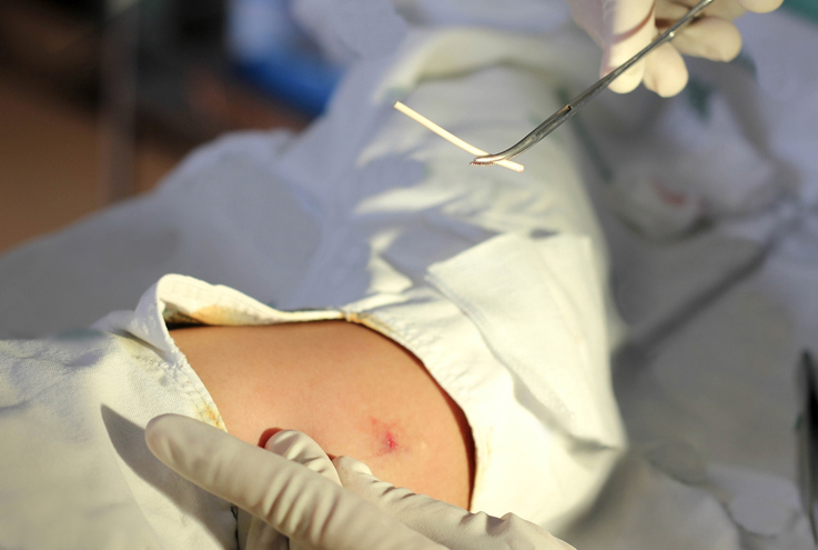 Birth Control Implant