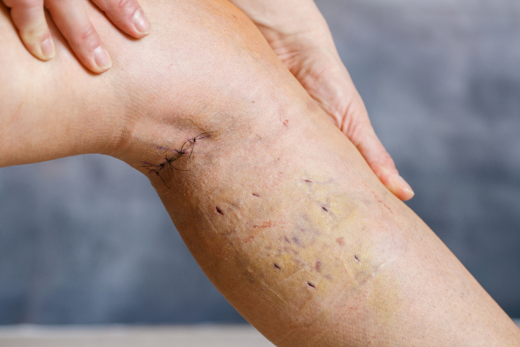 Varicose Vein Removal Surgery