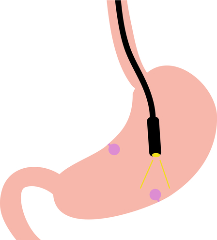 Endoscopic Submucosal Dissection (ESD)