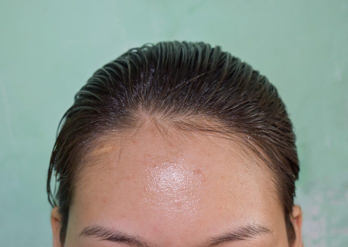 Forehead Reduction