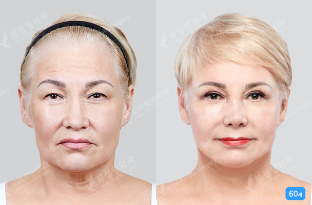 Benefits of facelift surgery