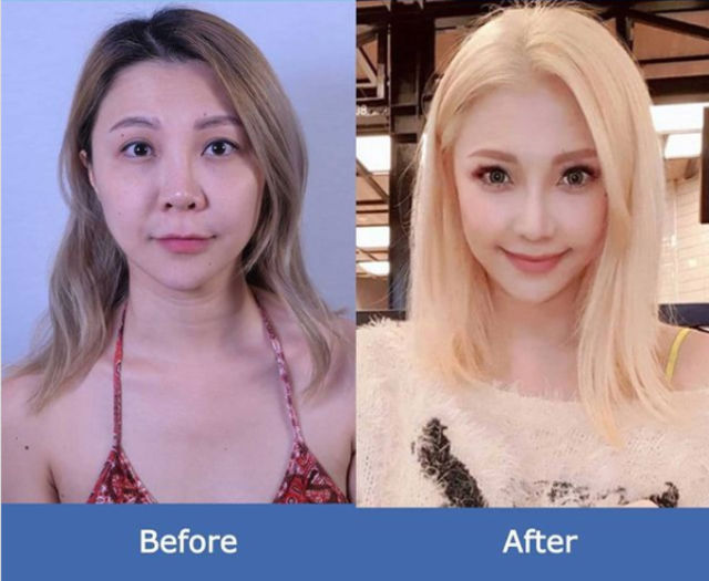 xiaxue before after