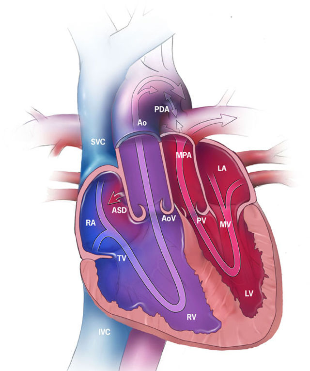 Arterial Switch