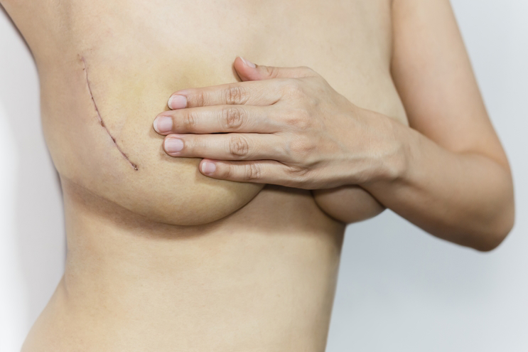 Partial Mastectomy