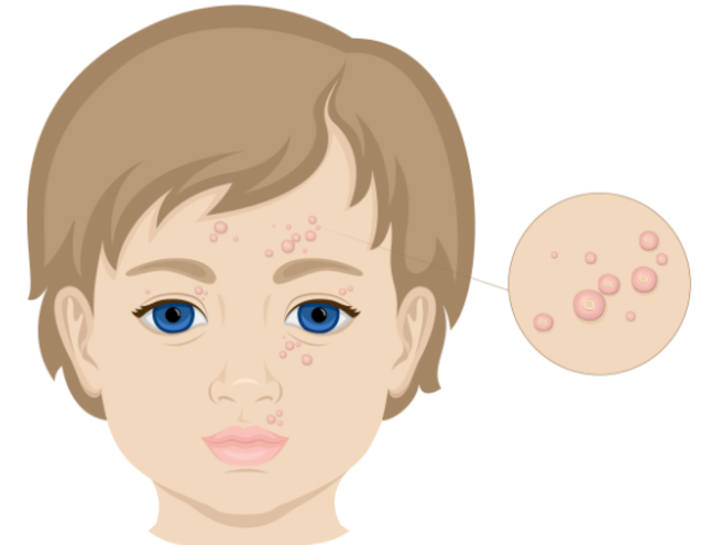 What Is Molluscum Contagiosum Symptoms Causes And Treatment 7598