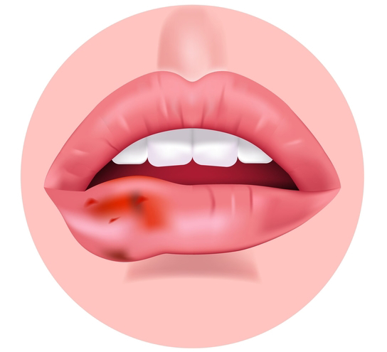 lip-cancer-what-you-really-need-to-know