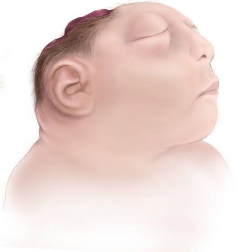 Anencephaly Causes Symptoms Diagnosis And Management   1 7536fc8e 8daa 48fd A664 59cd02032d92 