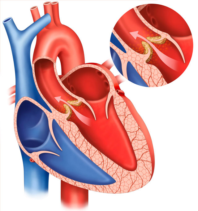 Remplacement valvulaire aortique