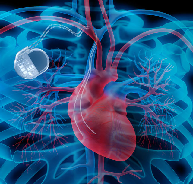 Implantation d’un stimulateur cardiaque