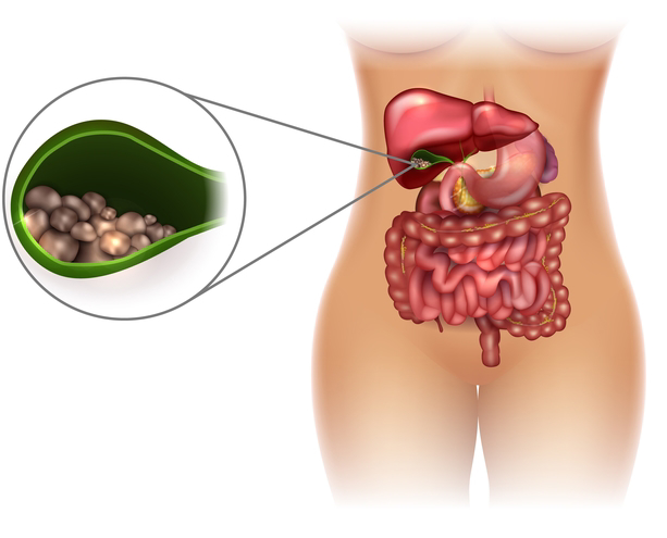 cholelithiasis