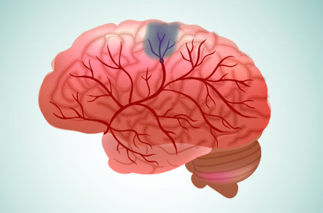 Cerebrovascular diseases