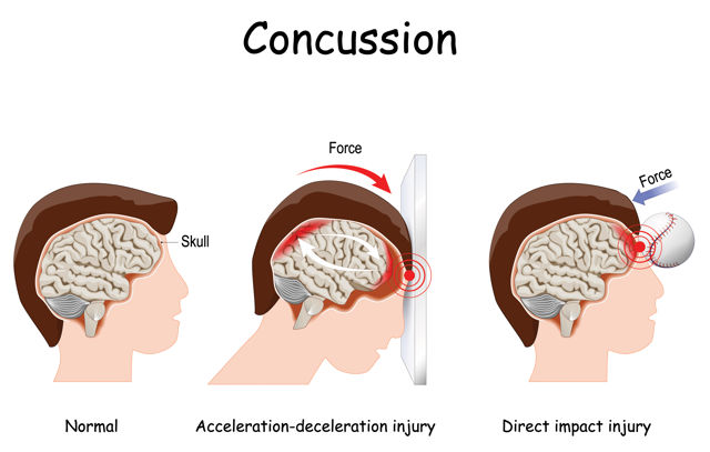 Concussion