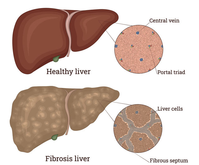 Liver fibrosis