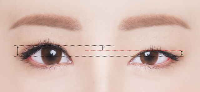 Ptosis Correction