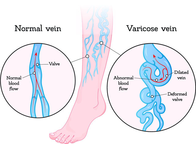 Venas Varicosas