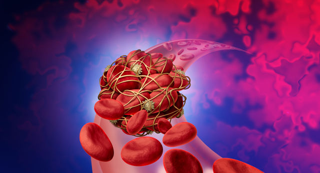 All you need to know about Blood Clots!