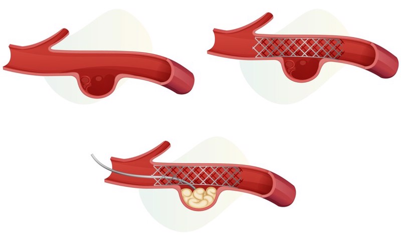 Endovascular Coiling