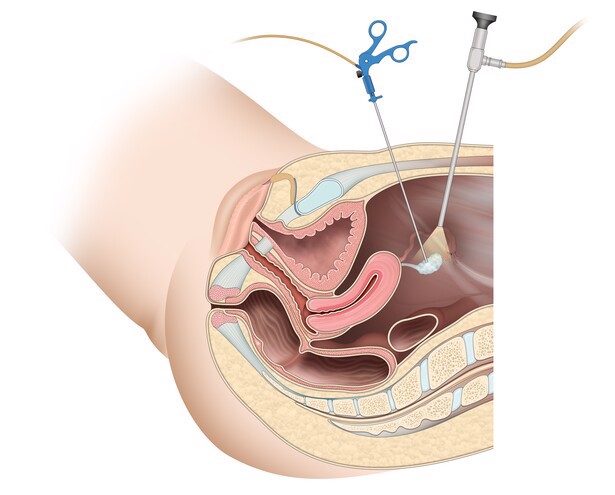 Phẫu thuật cắt bỏ u xơ tử cung nội soi