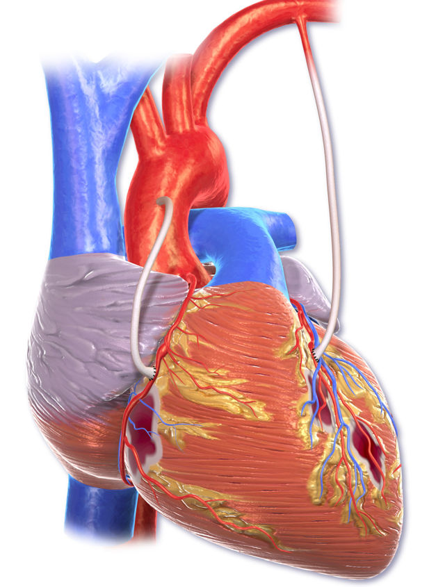Pontage aortocoronarien (PAC)  Aperçu Le CABG est une intervention chirurgicale importante dans laquelle les obstructions athéromateuses dans les artères coronaires d’un patient sont contournées à l’aide de conduits veineux ou artériels prélevés. Le pontage rétablit le flux sanguin vers le myocarde ischémique, rétablissant la fonction et la viabilité et soulageant les symptômes angineux. Près de 400 000 opérations du PAC sont effectuées chaque année, ce qui en fait la chirurgie chirurgicale majeure la plus régulièrement pratiquée; cependant, les tendances chirurgicales ont changé à mesure que les choix alternatifs tels que la thérapie médicale et l’intervention coronarienne percutanée (ICP) sont devenus plus populaires.   Chirurgie CABG Le pontage aortocoronarien (PAC) est une procédure utilisée pour améliorer la qualité de vie et minimiser la mortalité cardiaque chez les personnes atteintes de maladie coronarienne (CAD). La coronaropathie est la principale cause de décès aux États-Unis et dans le monde industrialisé, touchant 16,5 millions d’adultes américains (âgés de 20 ans) chaque année. Il est responsable de 530 989 décès aux États-Unis chaque année, et les conséquences à long terme de la coronaropathie, y compris la dysfonction ventriculaire gauche et l’insuffisance cardiaque, devraient toucher près de 8 millions de personnes de plus de 18 ans d’ici 2030. La chirurgie CABG a été réalisée pour la première fois dans les années 1960 dans le but de fournir un soulagement symptomatique, une meilleure qualité de vie et une espérance de vie accrue aux patients atteints de coronaropathie. Par rapport au traitement médical, le PAC a augmenté les taux de survie chez les personnes atteintes de la maladie multivasculaire et de la maladie principale gauche dans les années 1970. Le nouveau paradigme du traitement CAO demande une approche d’équipe cardiaque dans laquelle le cardiologue et le chirurgien cardiaque évaluent ensemble l’angiographie coronarienne et fournissent au patient la meilleure alternative disponible pour la revascularisation coronarienne, qu’il s’agisse de l’implantation d’un stent coronarien percutané ou d’un PAC. À l’heure actuelle, le patient moyen du PAC est plus âgé, a déjà subi une intervention coronarienne percutanée (ICP) et présente beaucoup plus de comorbidités. Malgré ces risques, le PAC reste l’une des opérations chirurgicales les plus importantes de l’histoire de la médecine moderne, ayant probablement sauvé plus de vies et offert un soulagement symptomatique plus considérable que toute autre chirurgie majeure. De nouvelles approches mini-invasives, des percées dans la gestion de l’anesthésie et des unités de soins intensifs (USI) et les progrès technologiques repoussent les limites de cette opération vers de nouveaux sommets. En général, il existe deux types d’interventions chirurgicales CABG: à la pompe et hors pompe, à la différence qu’un CABG à la pompe utilise un circuit de pontage cardiopulmonaire et un cœur arrêté pour travailler. L’artère mammaire interne gauche (LIMA) et les greffes de veine saphène (SVG) des membres inférieurs sont couramment utilisées comme conduits de pontage. L’artère mammaire interne droite (RIMA), l’artère radiale et l’artère gastroépiploïque sont quelques-uns des autres conduits qui peuvent être transplantés. Le type et la position des greffons sont déterminés par l’anatomie du patient et l’emplacement des artères bloquées. Le LIMA est généralement greffé à l’artère descendante antérieure gauche (LAD), tandis que les autres conduits sont utilisés pour accéder aux autres artères bloquées.   Anatomie et physiologie  Deux artères coronaires majeures alimentent le myocarde du cœur : l’artère coronaire principale gauche et l’artère coronaire droite (RCA). L’artère coronaire principale gauche est généralement une courte section qui se divise en artères descendantes antérieures gauches (LAD) et circonflexes. Le LAD se divise en branches diagonales, tandis que l’artère circonflexe se divise en branches marginales obtuses. La RCA se divise en deux branches : l’artère descendante postérieure (PDA) et les branches marginales. Selon l’artère qui alimente le septum interventriculaire et le PDA, la circulation coronaire peut être classée en systèmes à dominante gauche, à dominante droite et à co-dominante. L’artère circonflexe alimente le PDA dans un système à dominante gauche, tandis que le RCA alimente le PDA dans un système à dominante droite. Avec un apport vasculaire co-dominant, le PDA est alimenté à la fois par le RCA et les artères circonflexes en même temps. Les blocages dans l’une des artères coronaires entraînent une déficience correspondante de la perfusion myocardique, une ischémie et, si elles ne sont pas traitées, peuvent entraîner un infarctus permanent ou des dommages au cœur.   Informations historiques  En 1912, Alexis Carrel a reçu le prix Nobel de physiologie et de médecine pour ses travaux. Sa connaissance de la relation entre l’angine de poitrine et la sténose de l’artère coronaire lui a permis d’anastomose un segment de l’artère carotide de l’aorte thoracique descendante à l’artère coronaire gauche dans un modèle canin. Arthur Vineberg, un chirurgien canadien de renom, a transplanté l’artère thoracique interne gauche (mammaire) directement dans le myocarde du ventricule gauche antérieur chez des patients atteints d’angine de poitrine sévère à la fin des années 1940. Étonnamment, quelques personnes ont eu une réduction considérable des symptômes à la suite de cette chirurgie. Sabiston a mené la première procédure planifiée de pontage veineux saphène pour la revascularisation coronaire à l’Université Duke en 1962. Kolessov a utilisé l’artère thoracique interne gauche (mammaire) pour contourner l’artère descendante antérieure gauche sans pontage cardiopulmonaire en 1964, et Carpentier a été le pionnier de l’utilisation de greffes d’artère radiale comme conduits CABG en 1973. Le CABG a prospéré en tant que seul traitement de la coronaropathie tout au long des années 1970 et au début des années 1980. Le nombre de chirurgies CABG effectuées a diminué avec le développement, l’introduction et l’adoption généralisée de l’endoprothèse coronarienne percutanée dans les années 1980 et 1990. Plusieurs essais multicentriques comparant le CABG au traitement actuel par stent ont toutefois clairement établi les avantages du CABG, en particulier lorsque des caractéristiques spécifiques du patient telles que le diabète, la coronaropathie multivasculaire et la cardiomyopathie ischémique sont incluses.   Indications pour CABG  Lorsqu’il y a des blocages de haut grade dans l’une des principales artères coronaires et / ou que l’intervention coronarienne percutanée (ICP) n’a pas réussi à éliminer les blocages, LE PAC est souvent conseillé. Voici les recommandations de classe 1 des lignes directrices de l’ACCF/AHA de 2011 : Maladie principale gauche supérieure à 50% Maladie coronarienne à trois vaisseaux supérieure à 70 % avec ou sans atteinte proximale de la LAD Maladie à deux vaisseaux : LAD plus une autre artère majeure Une sténose sévère de plus de 70% chez un patient présentant des symptômes angineux considérables malgré un traitement médicamenteux maximal Chez un survivant de mort subite cardiaque avec tachycardie ventriculaire liée à l’ischémie, une maladie vasculaire était supérieure à 70%.   D’autres indications pour CABG sont les suivantes: Angine invalidante (classe I) Ischémie qui persiste dans le contexte d’un infarctus du myocarde avec élévation du segment non ST (NSTEMI) réfractaire au traitement médicamenteux (classe I) Mauvaise fonction ventriculaire gauche, mais viable, myocarde non fonctionnel au-dessus du défaut anatomique qui peut être revascularisé. Coronaropathie cliniquement sévère avec une sténose de 70 % ou plus dans un ou plusieurs vaisseaux, ainsi qu’une angine réfractaire malgré le traitement médicamenteux et l’ICP Coronaropathie cliniquement sévère de 70 % ou plus de sténose dans 1 vaisseau ou plus chez les survivants d’un arrêt cardiaque soudain que l’on pense être causé par une arythmie ventriculaire ischémique Coronaropathie cliniquement sévère avec 50% ou plus de sténose dans 1 vaisseau ou plus chez les patients subissant une chirurgie cardiaque pour d’autres raisons (par exemple, remplacement valvulaire ou chirurgie aortique) Le CABG peut être effectué comme traitement d’urgence dans le cadre d’un IM d’élévation du segment ST (STEMI) si l’intervention coronarienne percutanée (ICP) n’a pas été possible ou si l’ICP a échoué et qu’il y a une douleur et une ischémie prolongées affectant une grande partie du myocarde malgré le traitement médicamenteux.   Les facteurs qui augmentent le bénéfice de survie de CABG sont les suivants: Fraction d’éjection ventriculaire gauche de 45 % ou moins Diabète sucré Régurgitation mitrale ischémique Défaillance PCI, avec ou sans MI aigu (AMI)   Contre-indications Le PAC n’est pas recommandé pour les personnes asymptomatiques qui présentent un faible risque d’IM ou de décès. Les patients qui bénéficieront peu de la revascularisation coronarienne sont également exclus. Bien que l’âge avancé ne soit pas une contre-indication, le PAC doit être abordé avec prudence chez les personnes âgées, en particulier celles de plus de 85 ans. Ces personnes sont également plus susceptibles d’avoir des problèmes périopératoires après le PAC. Chez les patients atteints de coronaropathie compliquée, une approche d’équipe cardiaque multidisciplinaire mettant l’accent sur la prise de décision partagée est essentielle pour offrir au patient les meilleures chances d’un plan de revascularisation réussi.   Procédure CABG  En plus de l’angiographie coronarienne qui a détecté la maladie coronarienne, le patient aura besoin de divers tests effectués en préparation de la chirurgie. Des tests de laboratoire tels qu’une formule sanguine complète (FSC), des panels métaboliques comprenant des tests de la fonction hépatique, des panels de coagulation et de l’hémoglobine A1c seront nécessaires. D’autres tests, y compris un électrocardiogramme (ECG), une échocardiographie, une échographie carotidienne, une radiographie pulmonaire et peut-être une cartographie thoracique ou veineuse des membres inférieurs, peuvent être nécessaires. Pour éviter les arythmies telles que la fibrillation auriculaire, des médicaments préopératoires tels que les bêta-bloquants sont fréquemment administrés pendant la période périopératoire. Auparavant, l’aspirine était retenue 5 à 7 jours avant la chirurgie, mais il est maintenant suggéré de commencer ou de continuer avant l’opération. Lorsque le patient arrive à l’hôpital, l’accès intraveineux sera établi et ses médicaments et tests préopératoires seront examinés. Les cheveux seront retirés des lieux de la chirurgie et le patient recevra un bain de chlorhexidine.   Équipement Cette chirurgie importante nécessite non seulement l’équipement requis pour la plupart des autres opérations chirurgicales, mais également plusieurs équipements spécialisés, tels qu’un appareil de pontage cardiopulmonaire avec un appareil chauffant-refroidisseur pour réchauffer et refroidir le sang.    Personnel L’opération est réalisée par une équipe chirurgicale cardiovasculaire spécialisée avec une formation et une expérience approfondies dans la prise en charge de ces patients complexes. L’équipe est composée du chirurgien cardiothoracique et de leurs assistants, anesthésiologistes, infirmières, techniciens chirurgicaux et perfusionnistes.   Évaluation des risques Des modèles de risque pour prédire la mortalité à 30 jours après un PAC isolé sont en cours d’élaboration. Les prédicteurs les plus souvent utilisés en chirurgie cardiaque sont le système Euroscore et le modèle de risque de chirurgie cardiaque 2008 de la Society of Thoracic Surgeons (STS). L’âge, l’IM antérieur, la PVD, l’insuffisance rénale, le statut hémodynamique et l’EF sont tous des facteurs partagés dans ces deux modèles exceptionnels. Huit des facteurs les plus pertinents, y compris l’âge, l’acuité chirurgicale, l’état réopératoire, le taux de créatinine, la dialyse, le choc, la maladie pulmonaire chronique et l’EF, expliquent 78% de la variation du modèle STS.    Prémédication La prémédication vise à réduire les besoins en oxygène du myocarde en abaissant la fréquence cardiaque et la pression artérielle systémique, ainsi qu’à augmenter le flux sanguin myocardique à l’aide de vasodilatateurs. Les médicaments suivants doivent être pris jusqu’au moment de la chirurgie: Bêta-bloquants, bloqueurs des canaux calciques et nitrates Aspirine Les agents administrés sont les suivants : Témazépam immédiatement préopératoire Midazolam, une petite dose intraveineuse (IV) dans la salle d’opération avant l’insertion de la ligne artérielle Chaque patient doit obtenir 2 unités de sang (pour les cas bénins) ou 6 unités de sang, du plasma frais congelé et des plaquettes croisées (pour les cas complexes). L’acide tranexamique (bolus de 1 g avant l’incision chirurgicale, suivie d’une perfusion de 400 mg / h pendant la chirurgie) peut être envisagé pour minimiser l’hémorragie médiastinale postopératoire et la quantité de produits sanguins nécessaires (c.-à-d. globules rouges et plasma frais congelé)   Anesthésie La chirurgie cardiaque est le plus souvent réalisée sous anesthésie générale profonde avec tube endotrachéal. Les deux types suivants de blocage neuraxial sont rarement utilisés comme adjuvants: Perfusion intrathécale d’opioïdes Anesthésie péridurale thoracique (généralement une perfusion locale d’anesthésique local / opioïde à faible dose)   Technique  Le processus commence une fois que le patient est dans la salle d’opération et est connecté à des moniteurs standard. Avant d’induire une anesthésie générale, un anesthésiste peut insérer une ligne artérielle pour surveiller la pression artérielle du patient de manière invasive. Après l’induction de l’anesthésie générale et de l’intubation du patient, une ligne centrale pour l’accès veineux et un cathéter artériel pulmonaire peuvent être insérés, suivis de l’insertion d’un transducteur d’échocardiographie transœsophagienne. Avant l’incision chirurgicale, le patient est préparé stérilement et drapé, et un délai d’attente est administré. Le chirurgien effectue une sternotomie médiale pour préparer l’ablation du LIMA pour une utilisation comme conduit. Un assistant formé, généralement un adjoint au médecin, un premier assistant infirmier ou un autre chirurgien, utilise des procédures ouvertes ou assistées par vidéo pour enlever la veine saphène d’une ou des deux jambes en même temps. Après l’acquisition de conduits adéquats, le chirurgien prescrit une anticoagulation, le plus souvent de l’héparine, à administrer en préparation d’un pontage cardiopulmonaire (CPB). L’aorte et le cœur du patient sont cannulés centralement et le tube est connecté au circuit de pontage cardiopulmonaire. Après l’initiation de la CPB, le cœur est arrêté avec une cardioplégie à haute teneur en potassium afin que le chirurgien puisse anastomose les conduits récoltés vers les artères coronaires éloignées des obstructions. En tant que conduits pour le pontage aortocoronarien, des artères ou des veines peuvent être utilisées (CABG). Une publication clé de la Cleveland Clinic a prouvé les avantages de survie de la greffe de l’artère thoracique interne gauche (mammaire) à l’artère coronaire descendante antérieure gauche il y a de nombreuses années. C’est toujours vrai; en fait, si possible, la greffe bilatérale d’artère thoracique interne (mammaire) offre un avantage considérable pour la survie à long terme. Des preuves solides montrent que l’utilisation d’une greffe d’artère supplémentaire plutôt que d’une greffe veineuse est liée à de meilleurs résultats à long terme. La veine saphène plus grande et, en de rares occasions, la veine saphène courte sont les greffes veineuses les plus régulièrement utilisées, tandis que l’artère thoracique interne (mammaire) est la greffe d’artère la plus couramment utilisée. La greffe d’artère radiale a été réintroduite dans la pratique clinique dans les années 1990 et continue de démontrer des taux de perméabilité élevés de 80% ou plus après 10 ans de suivi, en particulier si la sténose vasculaire cible était supérieure à 90%. L’inconvénient des greffes de veines saphènes est que leur perméabilité diminue avec le temps: 10 à 20% sont bloqués 1 an après la chirurgie en raison d’erreurs techniques, de thrombose et d’hyperplasie intimale. Un autre 1-2 pour cent des greffes veineuses s’obstruent chaque année de 1 à 5 ans après la chirurgie, et un autre 4-5 pour cent occlus chaque année de 6 à 10 ans. L’occlusion du greffon veineux qui survient un ou plusieurs années après le CABG est causée par une athérosclérose par greffe veineuse, qui s’accompagne du développement d’une hyperplasie néointimale. Seulement 50 à 60% des greffes de veine saphène sont brevetées 10 ans après la chirurgie, et seulement la moitié d’entre elles sont exemptes d’athérosclérose angiographique. Les patients doivent prendre des médicaments antiplaquettaires à vie, le plus souvent sous la forme d’aspirine quotidienne à faible dose (81 mg), dans le cadre d’une prophylaxie secondaire appropriée. Les greffes d’artère thoracique interne (mammaire), contrairement aux greffes de veine saphène, maintiennent la perméabilité tout au long du temps. Plus de 90% des greffes d’artères thoraciques internes (mammaires) sont toujours brevetées après 10 ans. Lorsque l’artère coronaire antérieure gauche est contournée, l’artère thoracique interne gauche (mammaire) doit être utilisée comme conduit. Les conduits sont liés à une nouvelle ostie générée dans l’aorte proximale après que le chirurgien a anastomose les parties distales. La cardioplégie est ensuite rincée, le cœur commence à se contracter et le chirurgien peut examiner les greffons pour la circulation sanguine et la compétence, ainsi que les saignements des sites d’anastomose. La poitrine est ensuite fermée avec des fils sternaux et le patient est transféré à l’unité de soins intensifs pour la surveillance de la stabilité hémodynamique et l’extubation.   Complications Les accidents vasculaires cérébraux, l’infection des plaies, l’échec du greffe, l’insuffisance rénale, la fibrillation auriculaire postopératoire et la mortalité sont toutes des conséquences possibles du PAC. Le taux d’AVC après un PAC varie entre 1% et 2%, selon les caractéristiques du patient et les facteurs de risque d’AVC, qui comprennent l’âge avancé, l’AVC antérieur, l’athérosclérose aortique, la maladie artérielle périphérique, la fibrillation auriculaire périopératoire et le diabète. Les taux d’infection des plaies sternales sont d’environ 1% et sont affectés par des variables de risque telles que l’obésité, le diabète, la maladie pulmonaire obstructive chronique (MPOC) et la durée de l’opération. L’échec d’une greffe de veine saphène (SVG) est très probable dans les 30 jours suivant la chirurgie et est causé par de nombreuses raisons telles que la taille et la longueur excessive de la veine, le ruissellement distal et un mauvais débit, ainsi que l’hypercoagulabilité et la thrombose. Avec une angiographie répétée après CABG, des taux d’échec SVG allant jusqu’à 25% ont été observés. Alternativement, les greffes artérielles comme l’artère mammaire interne gauche (LIMA) et les greffes artérielles radiales durent plus longtemps et ont des taux de perméabilité qui atteignent 90% après 10 ans. Les taux d’insuffisance rénale postopératoire après le PAC varient de 2 % à 3 %, 1 % nécessitant une dialyse. La maladie rénale préopératoire, la vieillesse, le diabète, le type de chirurgie, le dysfonctionnement du LV et le choc sont tous des facteurs de risque. Bien qu’il n’ait été prouvé qu’aucun médicament ne diminue les taux d’insuffisance rénale induite par le PAC, le PAC hors pompe peut offrir un avantage par rapport au PAC à la pompe. La fibrillation auriculaire dans les 5 premiers jours suivant le PAC est plutôt fréquente, avec des taux allant de 20% à 50%, et est liée à une morbidité accrue, y compris un risque accru d’accident vasculaire cérébral embolique et de décès. La stratégie la plus efficace pour minimiser l’incidence de la fibrillation auriculaire postopératoire s’est avérée être un traitement préopératoire avec des bêta-bloquants et peut-être de l’amiodarone. Le risque de mortalité périopératoire à la suite d’un PAC varie en fonction des comorbidités, de l’urgence de la chirurgie et du volume de cas de l’établissement où l’intervention est effectuée, allant de 1 % à 2 %.    Résultats Selon une méta-analyse de six essais cliniques randomisés portant sur 6055 patients de l’ère de la greffe artérielle et de l’endoprothèse, le pontage aortocoronarien (CABG) entraîne une réduction de la mortalité à long terme et des infarctus du myocarde (IM) ainsi qu’une réduction des revascularisations répétées chez les patients atteints de maladie coronarienne multivasculaire, que les patients soient diabétiques ou non. Une méta-analyse de huit essais randomisés portant sur 3612 patients adultes atteints de diabète et de coronaropathie multivasculaire (CORONA) a révélé que le CABG réduisait le risque de décès toutes causes confondues de 33% après 5 ans par rapport à l’ICP. Lorsque les patients atteints de PAC ont été comparés à des sous-groupes de patients ayant reçu des stents en métal nu ou des stents à élution médicamenteuse, la diminution du risque relatif n’a pas varié de manière substantielle. Les patients âgés de 51 à 70 ans et ceux âgés de plus de 70 ans qui ont reçu un PAC au cours de la même période ont obtenu des résultats considérablement pires en termes de survie. L’insuffisance rénale chronique, une faible fraction d’éjection ventriculaire gauche, une maladie vasculaire périphérique ou une maladie pulmonaire obstructive chronique étaient les principaux facteurs de risque de décès toutes causes confondues. L’étude d’extension du traitement chirurgical de l’insuffisance cardiaque ischémique (STICH) (STICHES) a conclu que les taux de décès toutes causes confondues, de décès de causes cardiovasculaires et de décès de toute cause ou d’hospitalisation pour causes cardiovasculaires étaient significativement plus faibles chez les patients ayant subi un PAC et reçu l’assurance-maladie. De plus, il y avait une variance considérable au niveau hospitalier dans les taux de CABG STEMI, et CABG était fréquemment effectué dans les 1 à 3 jours suivant l’angiographie. Les patients qui ont reçu un PAC et ceux qui n’en ont pas reçu avaient des taux de mortalité similaires à l’hôpital. Une méta-analyse de 6637 patients atteints de coronaropathie principale gauche non protégée provenant de neuf essais sur une période de 14 ans (2003-2016) a révélé que l’ICP avec des stents à élution médicamenteuse était associée à une mortalité cardiaque et toutes causes confondues comparables, mais à des taux réduits d’AVC et à des taux plus élevés de revascularisation répétée. Pour les événements cardiaques et cérébrovasculaires indésirables significatifs, une tendance favorisant LE PAC par rapport à l’ICP n’a pas atteint de signification statistique. En termes de qualité de vie après CABG par rapport à PCI pour la CAO multivasculaire, les deux procédures améliorent la fréquence de l’angine de poitrine. Cependant, à 1 mois après la procédure, les patients atteints d’ICP ont tendance à se rétablir plus rapidement et à avoir un meilleur état de santé à court terme que les patients CABG, mais à 6 mois et plus longtemps après la procédure, les patients CABG semblent avoir un meilleur soulagement de l’angine et une meilleure qualité de vie que les patients PCI.   Conclusion   Un pontage aortocoronarien (PAC) est une technique chirurgicale utilisée pour traiter les maladies coronariennes dans le but d’améliorer la qualité de vie et de réduire la mortalité cardiaque. Il redirige le sang autour des sections rétrécies ou obstruées des artères principales, augmentant ainsi le flux sanguin et l’apport d’oxygène au cœur.