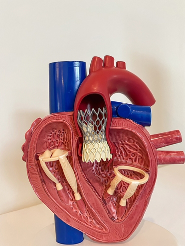 Transcatheter Aortic Valve Implantation (TAVI)