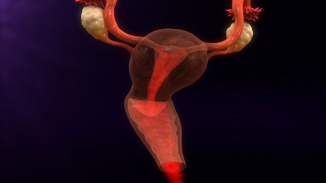 Endometrial Hyperplasia 