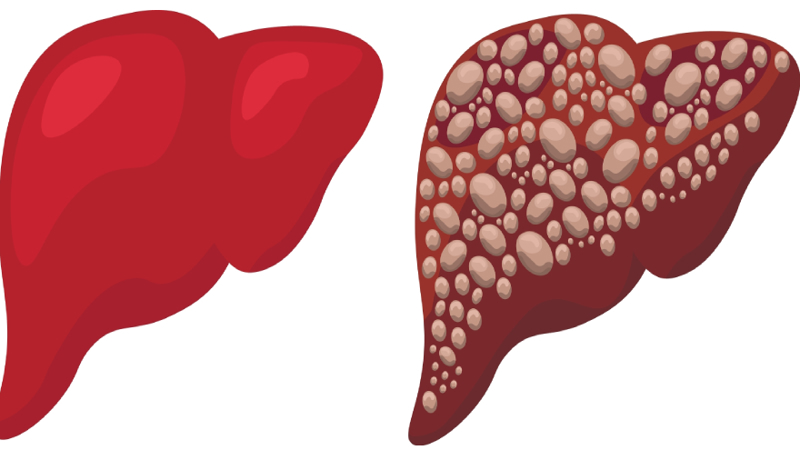 Alcohol Induced Hepatitis Symptoms And Management   10 3f04488c F0c6 4eb2 Bd6a C86b78d4e939 