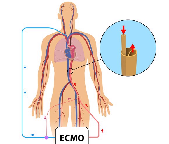 ECMO therapy