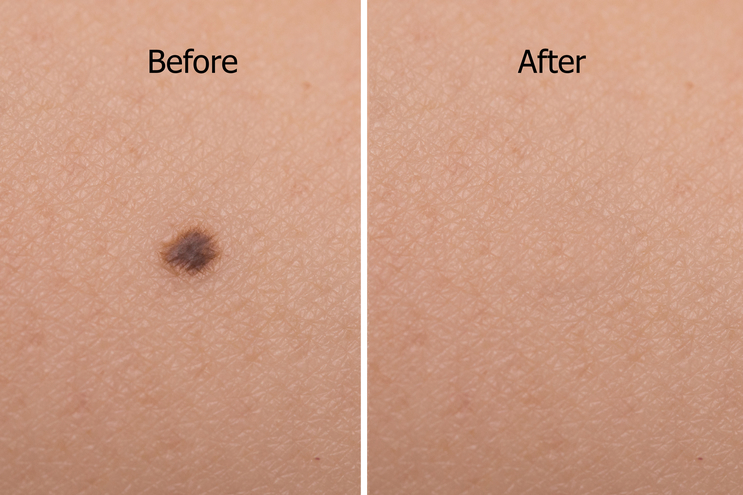 mole-removal