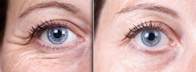 eye wrinkles treatments