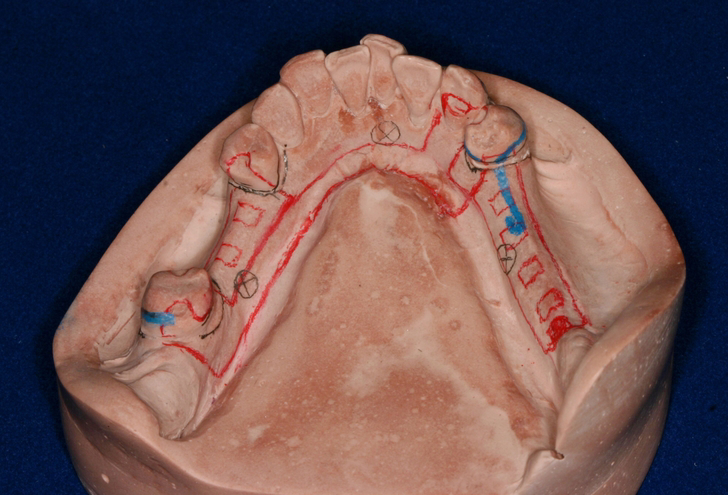 Các bộ phận của đúc răng giả một phần